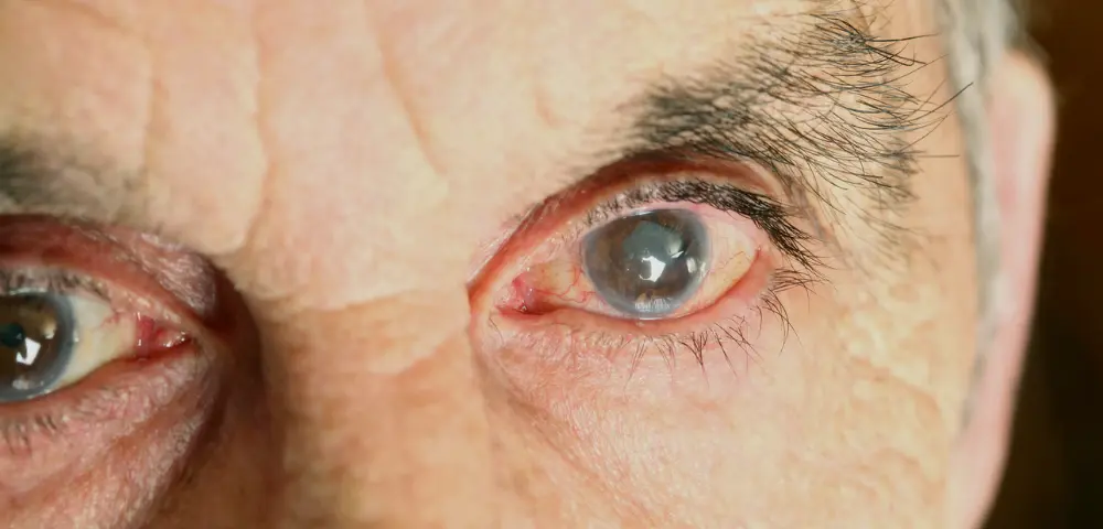 olho de homem com catarata