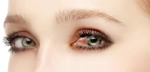 olho de mulher vermelho pterigio